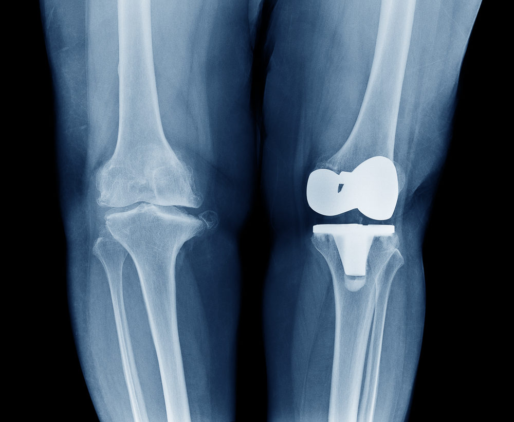 Knee Replacement Lawsuit Statute Of Limitations - Claims And Settlements